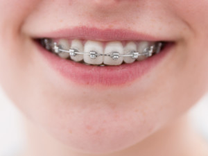 Ortodonzia, malocclusione e denti storti